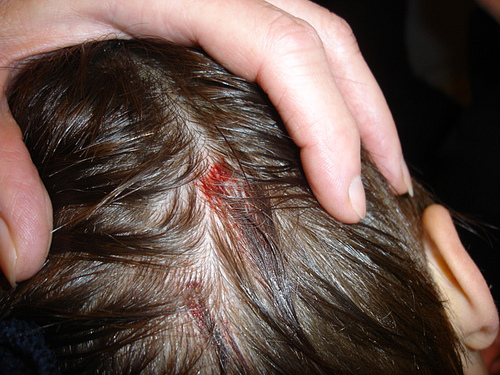 scalp photo