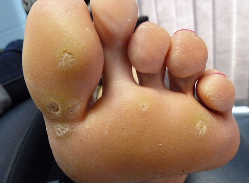 wart treatment photo